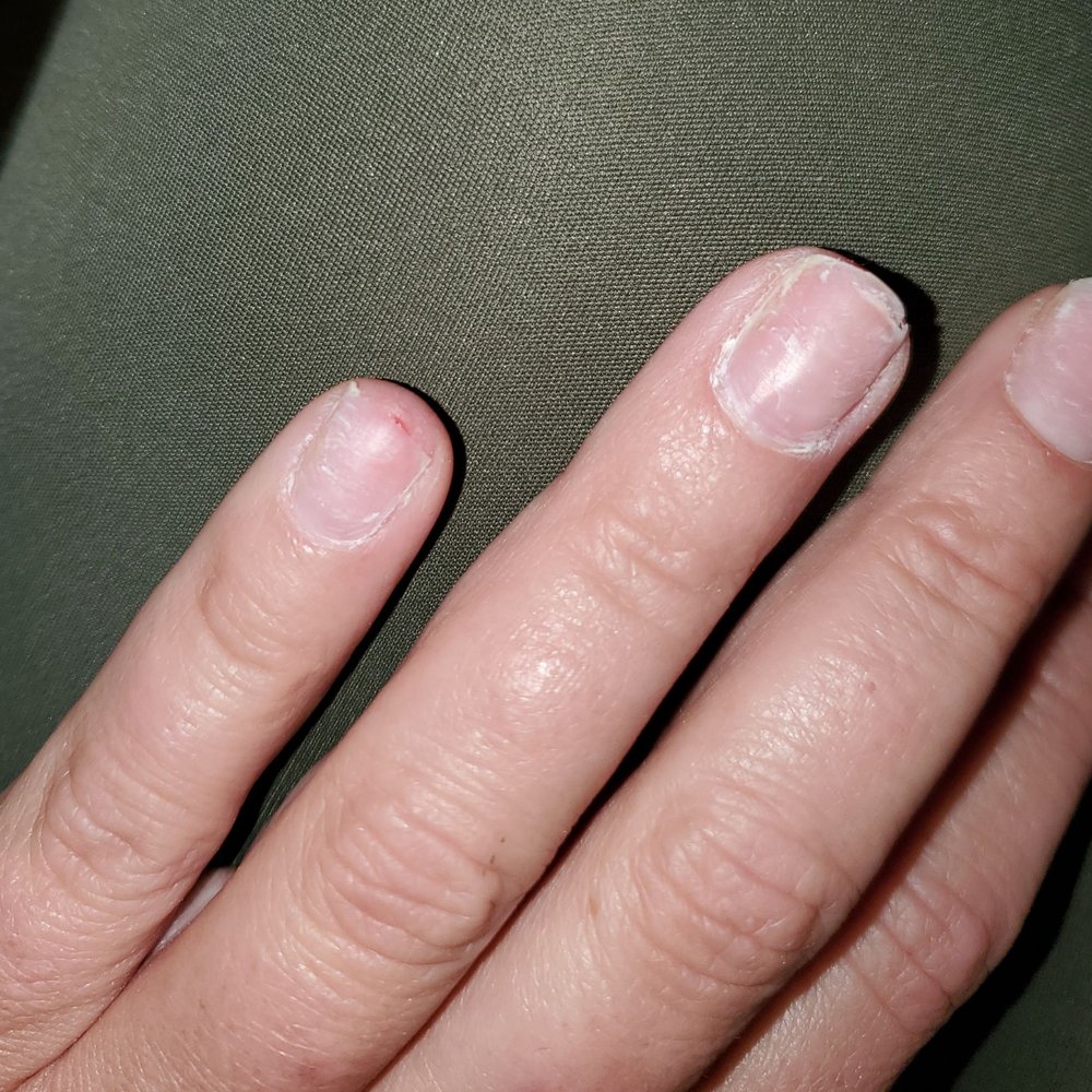 Acrylic nails ripped off, painful raw skin. Avoid Epic Nails!!!
