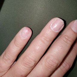 Acrylic nails ripped off, painful raw skin. Avoid Epic Nails!!!