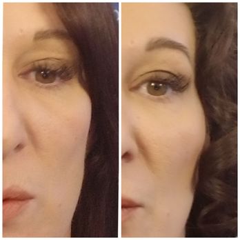 Victory Medical Spa - Before and after - Medical Spas Near Me - Cranston, Rhode Island Victory Medical Spa - Before and after - Medical Spas Near Me - Cranston, Rhode Island