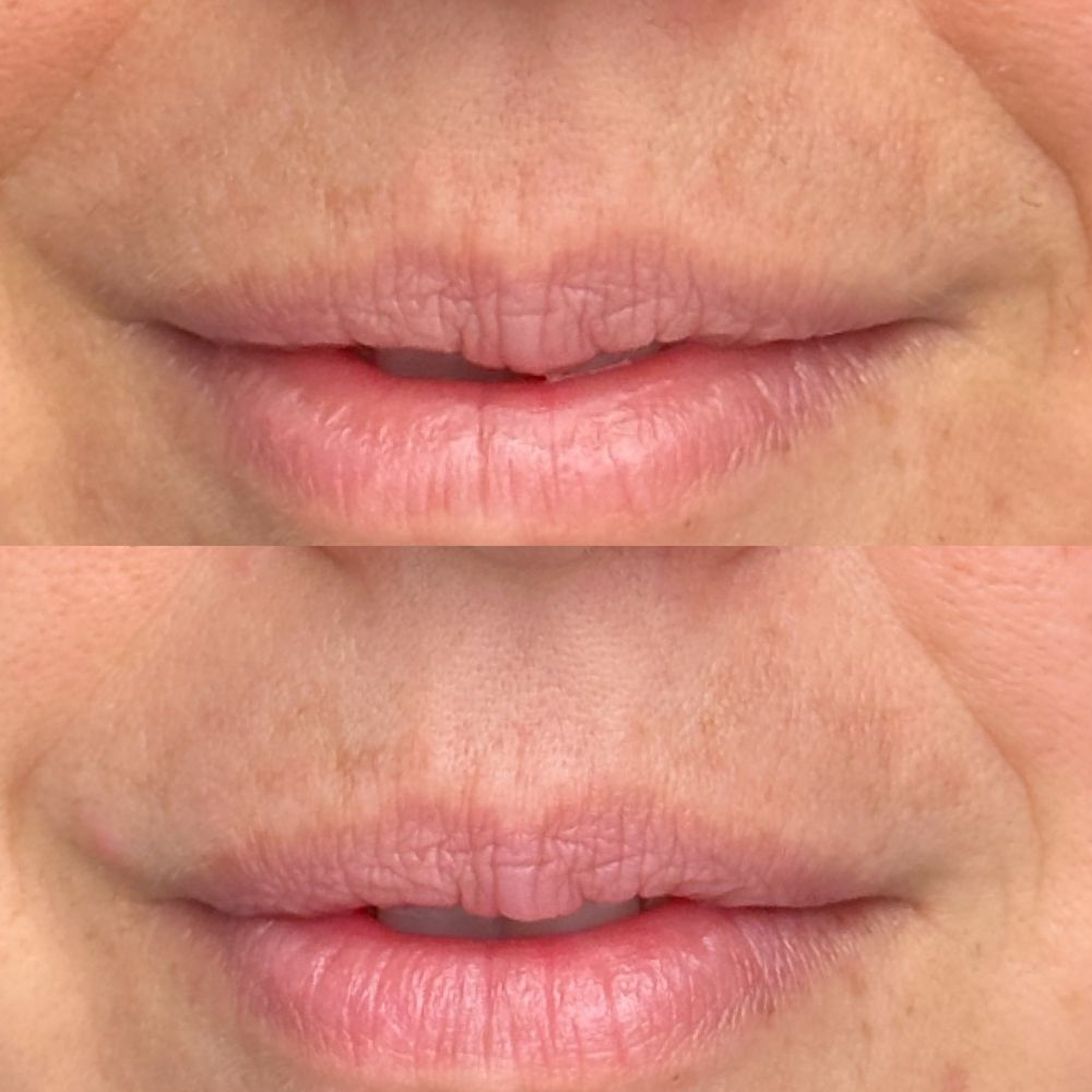 Fibroblast Facelift - After/ before - Skin Care Near Me - Pasadena, California