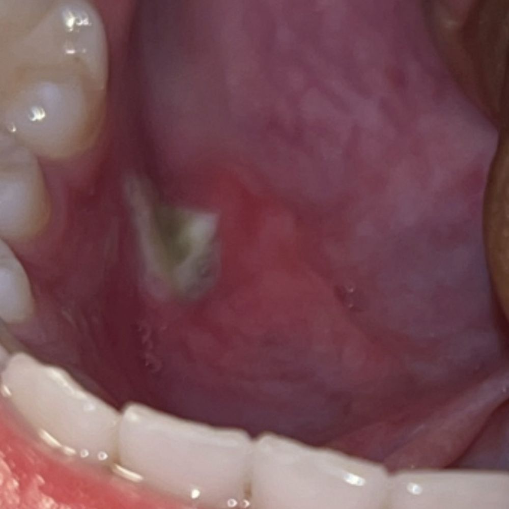 Adventure - Inside mouth - Orthodontists Near Me - Greeley, Colorado Adventure - Inside mouth - Orthodontists Near Me - Greeley, Colorado