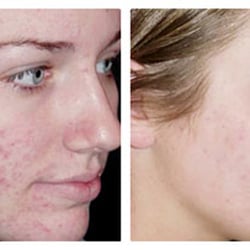 True Skin Laser Spa - Photofacial to reduce Acne