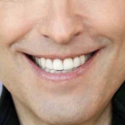 Joe Jeffrey DDS - 4 front veneers
