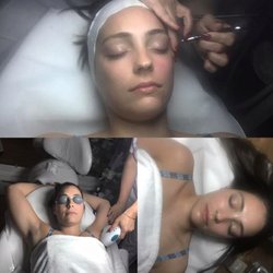 Microdermabrasion and IPL