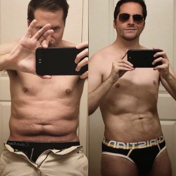 Athenix - Before/After MBC (Micro-Body Contouring Procedure) - Cosmetic Surgeons Near Me - Bellevue, Washington Athenix - Before/After MBC (Micro-Body Contouring Procedure) - Cosmetic Surgeons Near Me - Bellevue, Washington