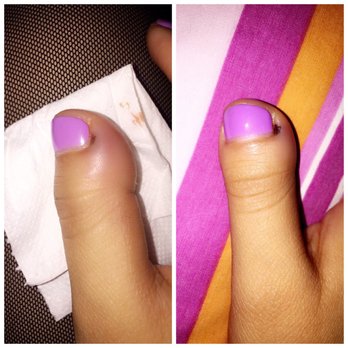 Quality Nails & Spa - Day After The Doctors , When They Had Already Poked Me & Squeezed The Pus Out, It Looked Worse But Unfortunately I Didn't Take Pictures .. - Nail Salons Near Me - Long Beach, California