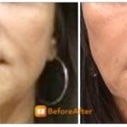Advanced Laser Aesthetics - Filler by ALA Injector, Shivali Dave - before (left) and after (right)