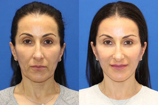 CARMEL VALLEY FACIAL PLASTIC SURGERY - Updated July 2025 - 135 Photos