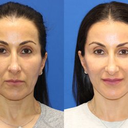Carmel Valley Facial Plastic Surgery - Before and After's 3 month post op. Vertical Restore, Custom Fat Transfer, Lower Lid Skin Pinch