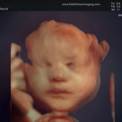 Fetal Vision Imaging - Second baby girl