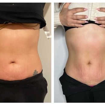 Be You Body - These are my results!!! - Body Contouring Near Me - Lakewood, California Be You Body - These are my results!!! - Body Contouring Near Me - Lakewood, California