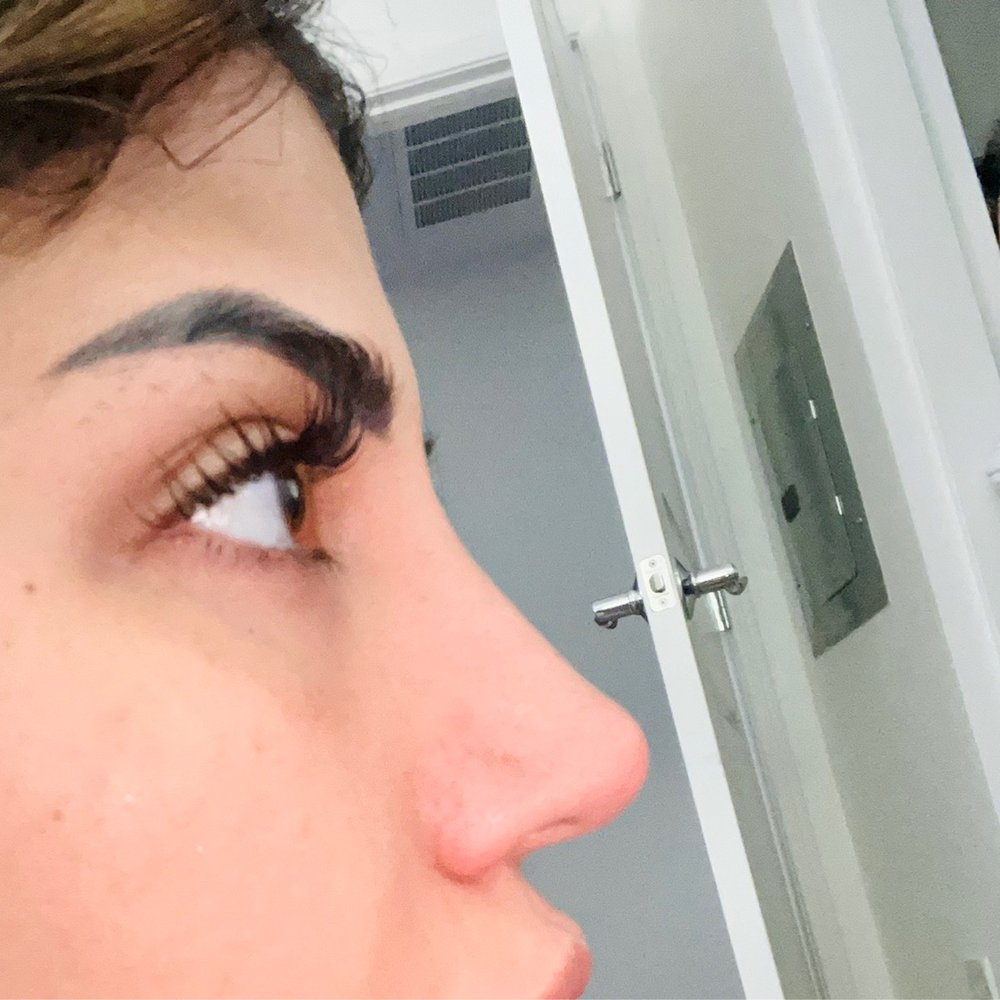 After 1 treatment My bridge is filled in and my tip is raised but subtly! Very natural but bold change. After 1 treatment My bridge is filled in and my tip is raised but subtly! Very natural but bold change.