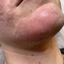 Electrolysis By Naz - After the hair is removed with electrolysis!