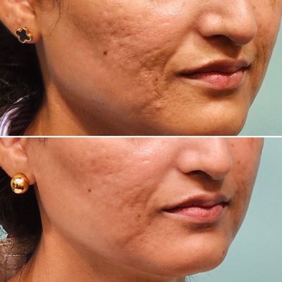 Skin Treatments - Skin Treatments include lasers, chemical peels, facials, Microneedling, Morpheus8, laser hair removal, hydra facials, light therapy and more. Skin Treatments - Skin Treatments include lasers, chemical peels, facials, Microneedling, Morpheus8, laser hair removal, hydra facials, light therapy and more.