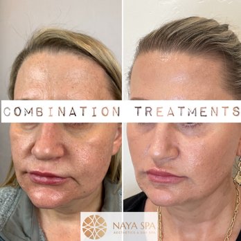 Naya Wellness - Before and after thread lift, lip filler and Botox. - Medical Spas Near Me - Chatsworth, California Naya Wellness - Before and after thread lift, lip filler and Botox. - Medical Spas Near Me - Chatsworth, California