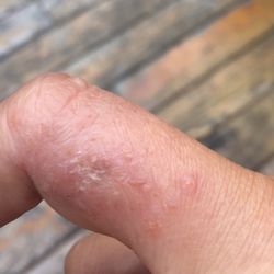 Jennifer Caudill, MD - Caudill Dermatology - Dermatitis-Before