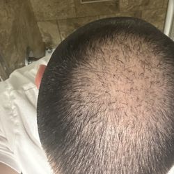 Bosley Hair Restoration & Transplant
