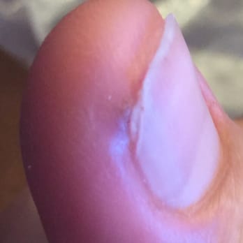 US Nails & Spa - The picture of my thumb that got infected from the manicure - Nail Salons Near Me - Chico, California US Nails & Spa - The picture of my thumb that got infected from the manicure - Nail Salons Near Me - Chico, California