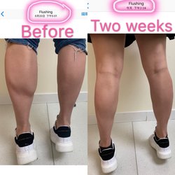 Ikare Beauty Medical Clinic - Leg slimming
