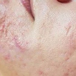 Permanent Make Up By Carolyn - BEFORE Micro-needling to remove scars, fine lines and wrinkles.
