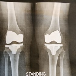 Jesse E. Bauwens, MD - So happy with my PERFECT KNEES thanks to Dr. Jesse Bauwens