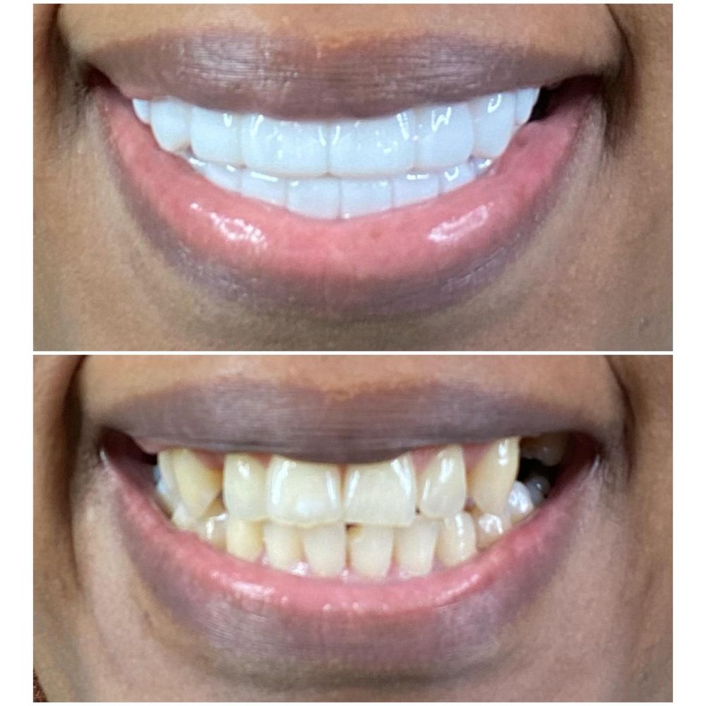 REMOVABLE VENEERS USA Updated September 2024 16 Photos 8611 Concord Mill Blvd, Concord