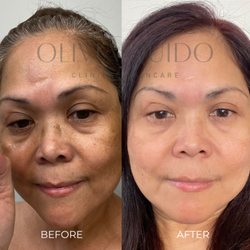 O Skin Medspa - Hyperpigmentation