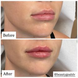 Beauty Goals LV - Lip enhancements