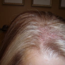 Seven days after hair transplant June 2013 Seven days after hair transplant June 2013
