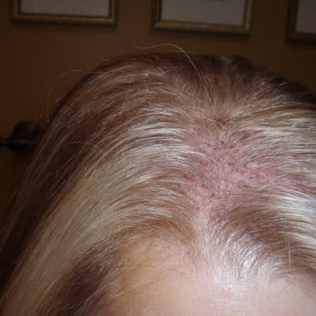 Jeffrey Epstein, MD, FACS - Seven days after hair transplant June 2013 - Hair Loss Centers Near Me - Miami, Florida Jeffrey Epstein, MD, FACS - Seven days after hair transplant June 2013 - Hair Loss Centers Near Me - Miami, Florida