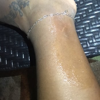 Spa Castle - Immediately after being burned. - Massage Near Me - College Point, New York