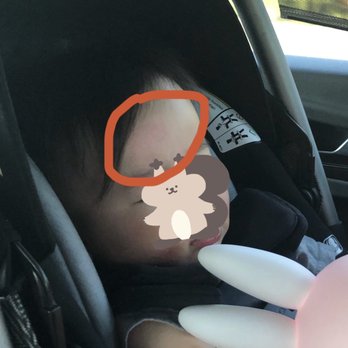 Woodblock - My son's forehead with a bump after tripped at the restaurant and we didn't get any apology, the manager and waiters were very rude. - Cocktail Bars Near Me - Redmond, Washington