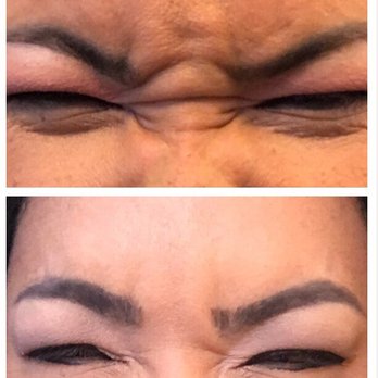 Serenity MedSpa - Squinting before and 3 weeks after Botox - Medical Spas Near Me - Burlingame, California Serenity MedSpa - Squinting before and 3 weeks after Botox - Medical Spas Near Me - Burlingame, California