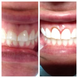 Joseph Elmassian, DDS - Before and after a 5 min procedure to push back my gums and expose more tooth. Making me look like I have an adult smile!