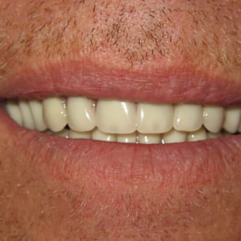 Arnold Cutler, DDS - Oral health improved with complete dentures - General Dentistry Near Me - Lakeside, California Arnold Cutler, DDS - Oral health improved with complete dentures - General Dentistry Near Me - Lakeside, California