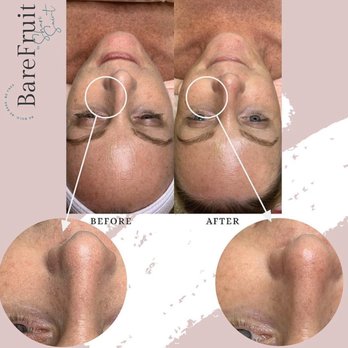 Bare Fruit Sugaring & Brows - Wantagh - Dermaplaning facials. - Sugaring Near Me - Wantagh, New York