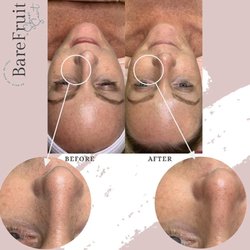 Bare Fruit Sugaring & Brows - Wantagh - Dermaplaning facials.