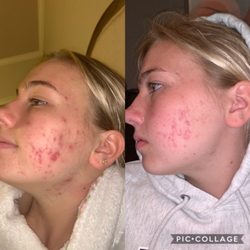 Timeless Aesthetics of Atlanta - Before & After Vivace RF Microneedling