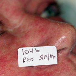 Ohio Laser & Wellness Centers - Before Rosacea