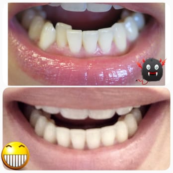Robert S Quinn, DMD MSD - Thanks Dr. Quinn for fixing that one tooth!! :) - Orthodontists Near Me - San Francisco, California Robert S Quinn, DMD MSD - Thanks Dr. Quinn for fixing that one tooth!! :) - Orthodontists Near Me - San Francisco, California
