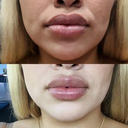 Top is with numbing cream before lip filler , bottom is right after injections Top is with numbing cream before lip filler , bottom is right after injections