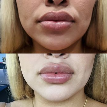 Serene Aesthetics & Wellness MedSpa - Top is with numbing cream before lip filler , bottom is right after injections - Medical Spas Near Me - Modesto, California Serene Aesthetics & Wellness MedSpa - Top is with numbing cream before lip filler , bottom is right after injections - Medical Spas Near Me - Modesto, California