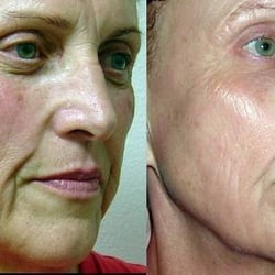 The Martin Center - Skin rejuvenation laser for brown spots and age spots
