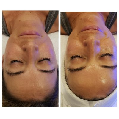 HydraFacial - The HydraFacial addresses all skin care needs:
-Fine Lines & Wrinkles
-Elasticity & Firmness
-Even Tone & Vibrancy
-Skin Texture
-Brown Spots
-Congested & Oily Skin
-Enlarged Pores HydraFacial - The HydraFacial addresses all skin care needs:
-Fine Lines & Wrinkles
-Elasticity & Firmness
-Even Tone & Vibrancy
-Skin Texture
-Brown Spots
-Congested & Oily Skin
-Enlarged Pores