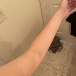 Babak Ghadishah, DO - This was the day that I first got my blood drawn from my left arm.