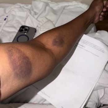 Mount Sinai Brooklyn - Bruises from being poked and prodded when they didn't have to because I have a port - Hospitals Near Me - Brooklyn, New York Mount Sinai Brooklyn - Bruises from being poked and prodded when they didn't have to because I have a port - Hospitals Near Me - Brooklyn, New York