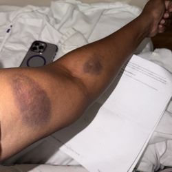 Mount Sinai Brooklyn - Bruises from being poked and prodded when they didn't have to because I have a port