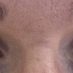 Lash Boutique - Chemical burn on bottom of eyes.