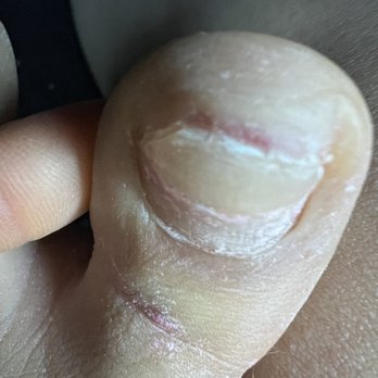 Polishhd Nail Bar - Painful nail bed exposed - Nail Salons Near Me - Phoenix, Arizona