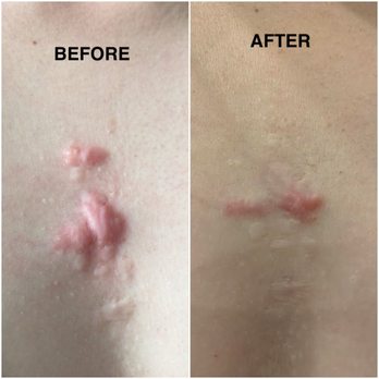 Raffy Karamanoukian, MD - 2018-- 2020. I just got another treatment from Dr. K after the "after pic". progress pics soon (takes a bit for laser redness to die down) - Cosmetic Surgeons Near Me - Santa Monica, California